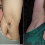 Techniques d'épilation durable et parfaite : épilation à la cire, épilation au fil, lotion épilatoire, épilation au laser, épilation électrique, épilation à la lumière pulsée