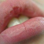 Peaux gercées en hiver : préventions et soins