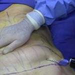 La liposuccion : Solution efficace pour remodeler son corps