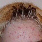 Soins des peaux acnéiques